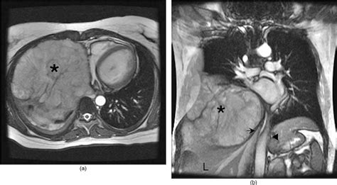 Figure 1 from Massive primary chest wall chondrosarcoma. | Semantic Scholar