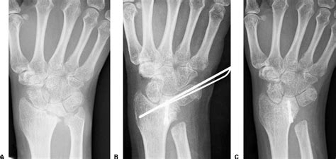 Clinical And Radiological Results Of Radiolunate Arthrodesis For