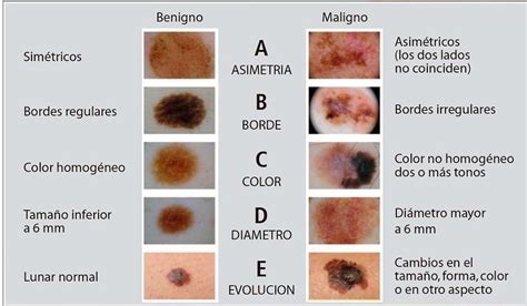 ¿cómo Saber Cuando Un Lunar Es Benigno O Maligno Especialista Enseña