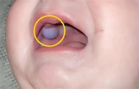 Mofo Na Boca Do Bebê - Mãe Fica em Alerta ao Ver a Boca do Bebé de 9 Meses – Diagnóstico dos ...