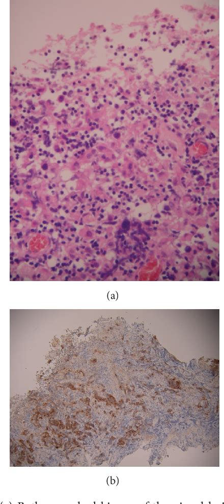 Figure 1 From A Rare Case Of A Pure Testicular Seminoma Presenting 7