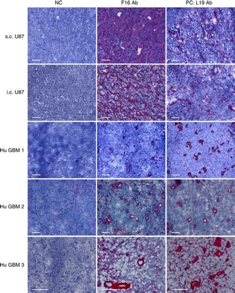 Immunohistochemical Analysis Of U Mg Human Glioblastoma Xenografts And