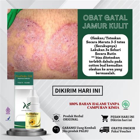 Jual Obat Dermatitis Atopik Seboroik Neurodermatitis, Obat Eksim Basah & Kering, Gatal, Kering ...