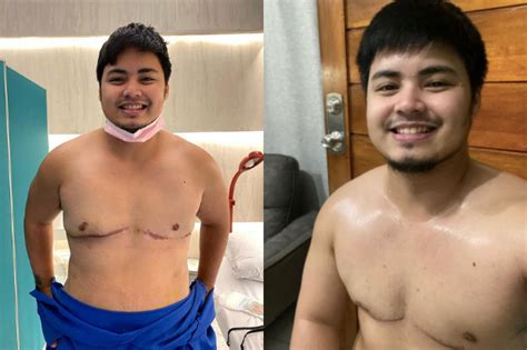 Jesi Corcuera Shows Chest Scars From Surgery As Trans Man Speaks Up On Being Free Inquirer