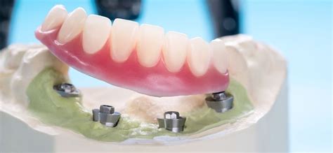 Traditional Vs Implant Supported Dentures San Ramon Ca Pro Smile