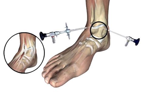 Artroscopia De Tobillo En M Rida Ortopedia Y Alta Especialidad Deportiva
