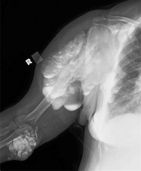 Figure From Secondary Tumoral Calcinosis With Intraosseous