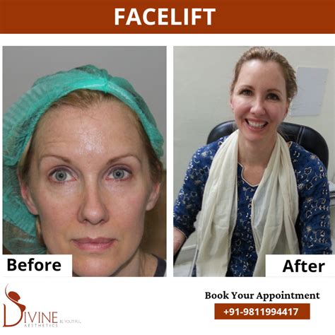 Facelift Before And After Images Facelift Surgery Result Gallery