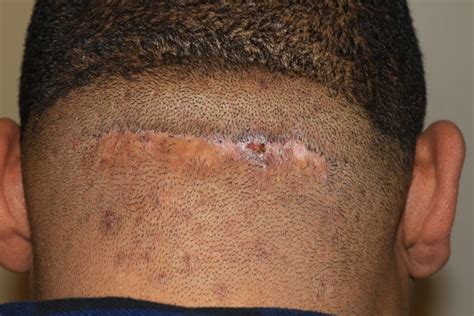 Scalp Keloid Results With Multi Modality Treatment Plan Keloid