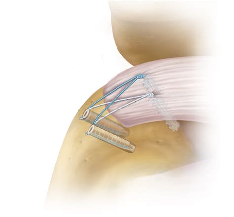 Arthrex T Cnica De Doble Fila Suturebridge