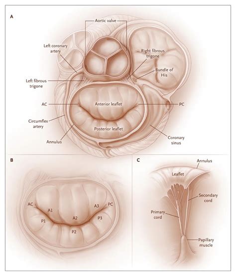 Mitral Valve Repair For Mitral Valve Prolapse Nejm