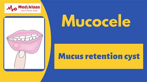 Mucocele L Clincial Features Histopathology Treatment L Oral Pathology L Mediklaas Youtube