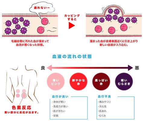 万能施術のカッピング吸い玉療法 大垣市しぶや接骨院 保険治療交通事故治療カッピングEMS骨盤矯正