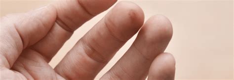 How to Treat Cracked Skin on Finger Tips | The Eczema Company Blog blog