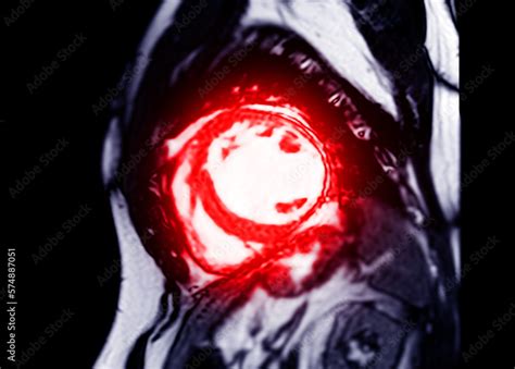 MRI Heart Or Cardiac MRI In Short Axis View Showing Cross Sections Of