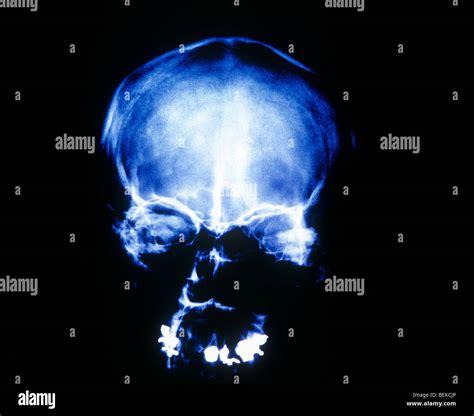 X-ray human skull Stock Photo - Alamy