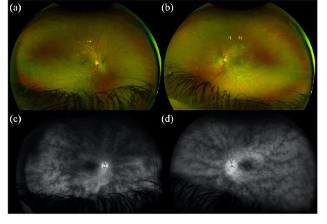 Multimodal Imaging In Pediatric Uveitis Semantic Scholar