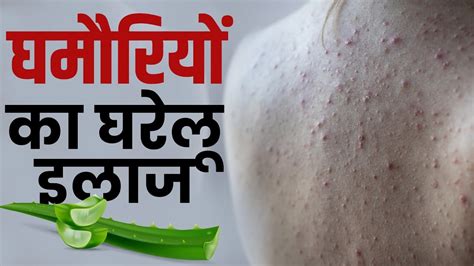 Ghamoriyon Ke Gharelu Ilaaj घमौरियों का इलाज हैं ये घरेलू उपाय Home Remedies For Heat Rash