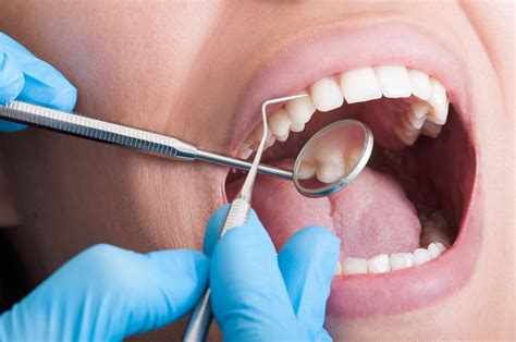 Sarro dental ¿Por qué se forma y como podemos eliminarlo?