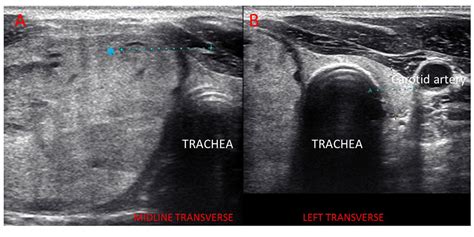 Isoechoic Thyroid Nodules Not Always Low Risk Benign