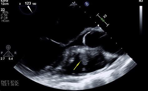 Isolated Pulmonic Valve Endocarditis Case Report And Review Of Existing Literature On Diagnosis