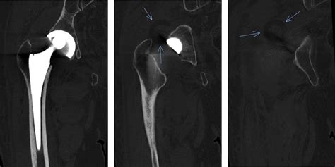 High Rate Of Early Intraprosthetic Dislocations Of Dual Mobility