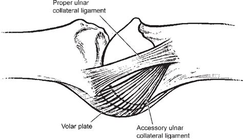 Figure 1 From Evaluation And Treatment Of Injuries Of The Ulnar