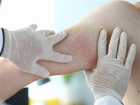 When Is A Drug Rash More Than Just A Rash Harvard Health