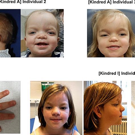 Molecular Genetic Findings In Individuals With Heterozygous CDH11