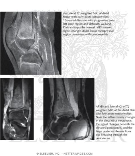 Osteomyelitis Mri Findings