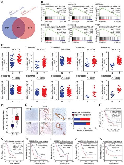 Pygl Mediated Glucose Metabolism Reprogramming Promotes Emt Phenotype