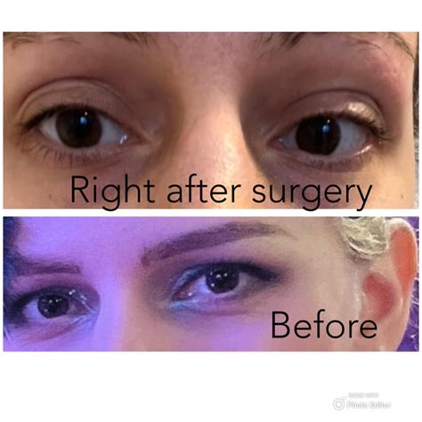 Upper eyelid surgery (hooded eyelids+non-asian) : r/PlasticSurgery