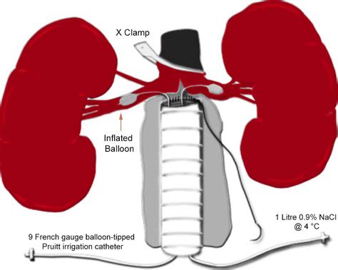 Continuous Crystalloid Renal Perfusion During Open Aaa Repair