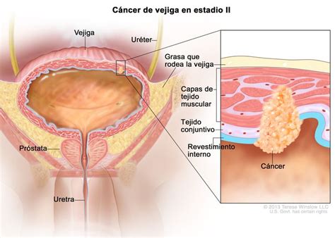 Estadios del cáncer de vejiga NCI