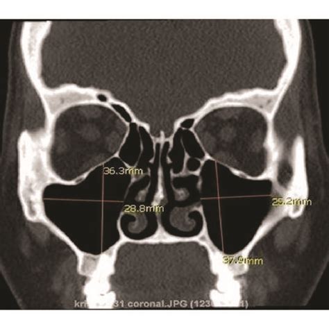 Linear Measurements Of Anteroposterior Dimensions Of Maxillary Sinus