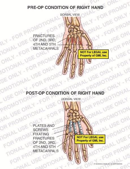 Pre Op And Post Op Condition Of Right Hand 96164a5b Generic Medical Legal Exhibits A Division