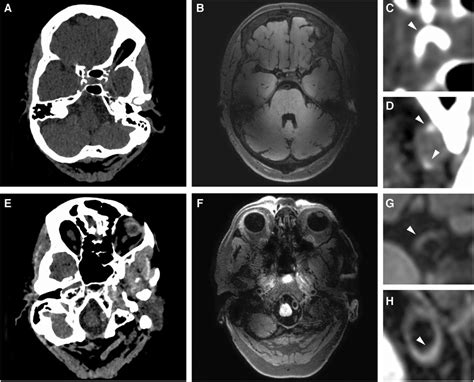 Frontiers Imaging Of Intracranial Arterial Disease A Comparison