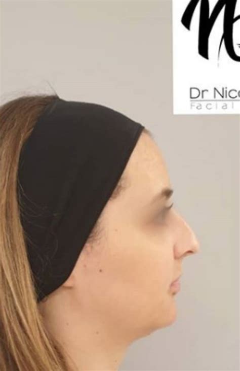 Rhinoplastie Médicale Injection Dacide Hyaluronique Au Nez Marseille