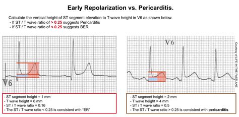 Acute Myocardial Infarction A Shifting Paradigm Recapem