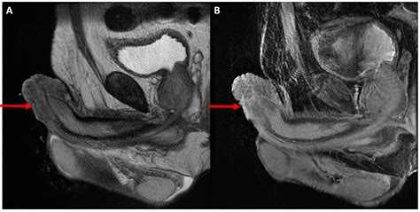 Imaging For The Initial Staging And Post Treatment Surveillance Of Penile Squamous Cell Carcinoma