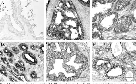 Figure From Tnf A Il Nf Kb Transduction Pathway In Human Cancer