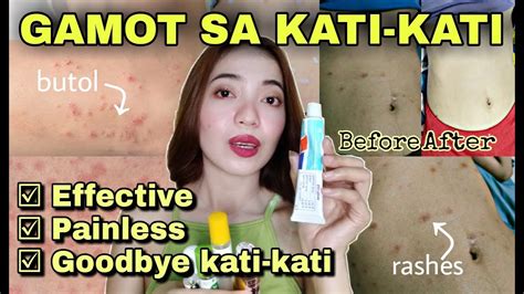 Mabisang Gamot Sa Kati Kati Ng Balat O Katawan Rashes Pantal Butol