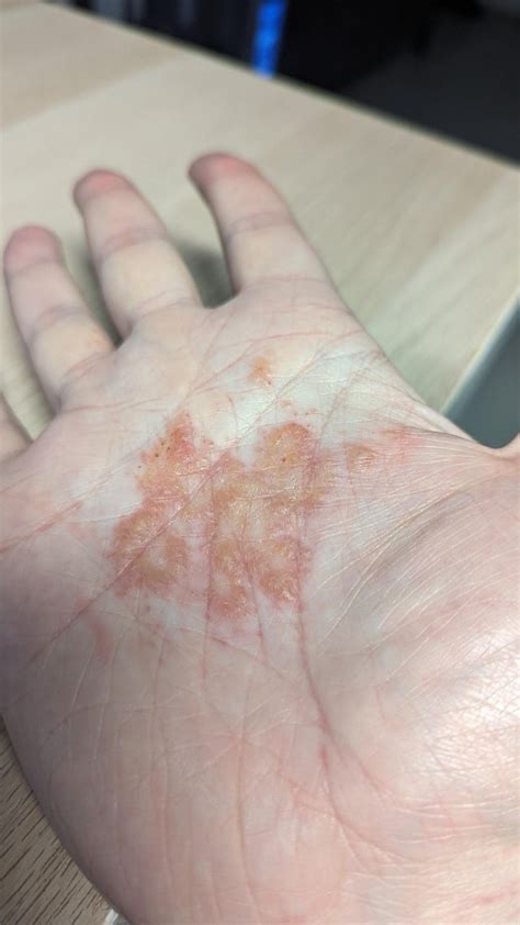 Whats Wrong With My Palm R Dermatologyquestions