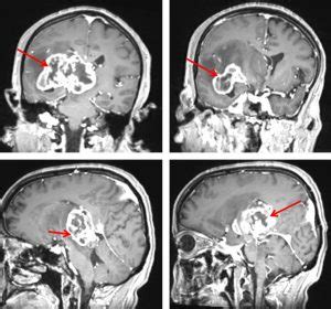 Glioblastoma Multiforme Radiology Cases