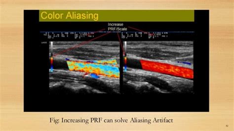 Doppler Effect Ultrasound