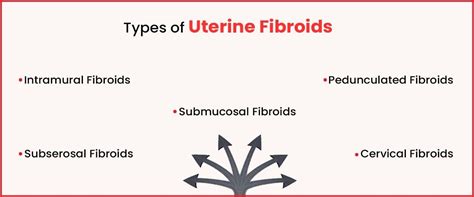 Uterine Fibroids Causes Symptoms Treatment Imprimis Ivf