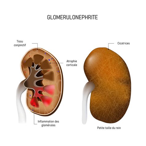 Glomerulonephritis: Causes, Signs, How To Treat?