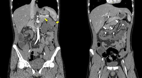 CBR Bradcases INTUSSUSCEPÇÃO INTESTINAL EM INDIVÍDUO JOVEM CAUSADO