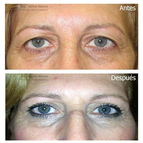 Blefaroplastia Superior Bilateral Antes Y Despu S Salom Abenza