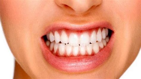 Bruxism And Tooth Grinding Arthur Street Dental